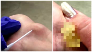 VIDEO: Žena měla na ruce obří cystu a rozhodla se ji vymáčknout šroubovákem! Nic nechutnější dnes neuvidíte