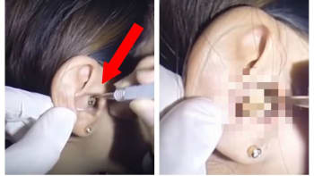 VIDEO: Žena si stěžovala na bolest ucha. Doktor jí z něj vytáhl tyto nechutné chuchvalce mazu. Nic odpornějšího jste neviděli!