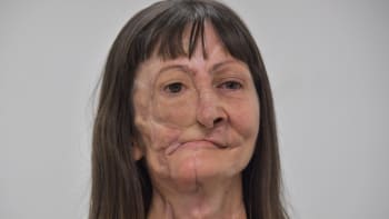 PROMĚNA: Ženě s rakovinou kůže změnila život náhrada poloviny tváře. Jak s ní teď vypadá?