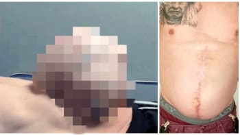 VIDEO: Děsivé video, které vystrašilo i lékaře. Muž měl v žaludku obří...