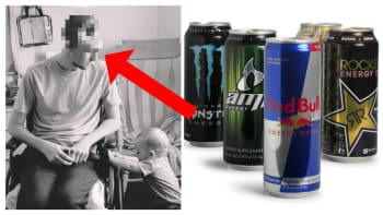 FOTO: Děsivé! Kvůli energetickým drinkům skoro přišel o život! Dál žije jen s půlkou hlavy