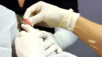 VIDEO: Doktorka odstranila muži z hlavy obří cystu plnou hnisu. Tohle budete mít navždy před očima