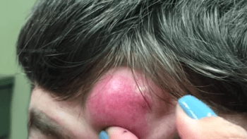 VIDEO: Muž měl na hlavě obří cystu a vypadal jako jednorožec. Z jejího vymačkávání se vám zvedne žaludek