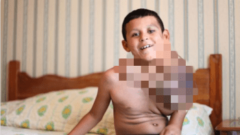 PŘÍBĚH: Chlapec se kvůli obřímu nádoru na krku málem udusil. Během operace mu pak visel život na vlásku