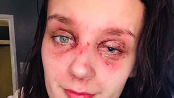 FOTO: Teenagerka skončila slepá poté, co jí v mikrovlnce explodovalo vejce do obličeje! Co jí to napadlo?