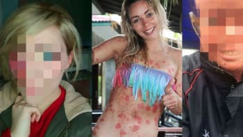 Bez cenzury! Hitem internetu se stávají dívky s kožním onemocněním, které ukazují svoji pravou tvář!