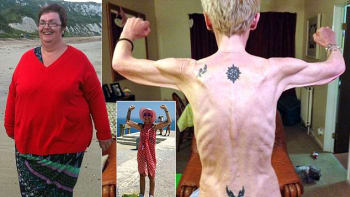 Z vorvaně anorektičkou. Tato žena  v průběhu dvou let zhubla 130 kg!
