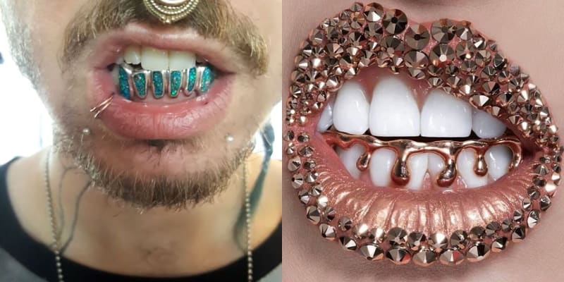 Šílený trend - zlaté zuby