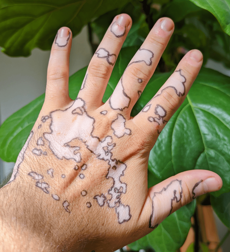 Vitiligo mapa