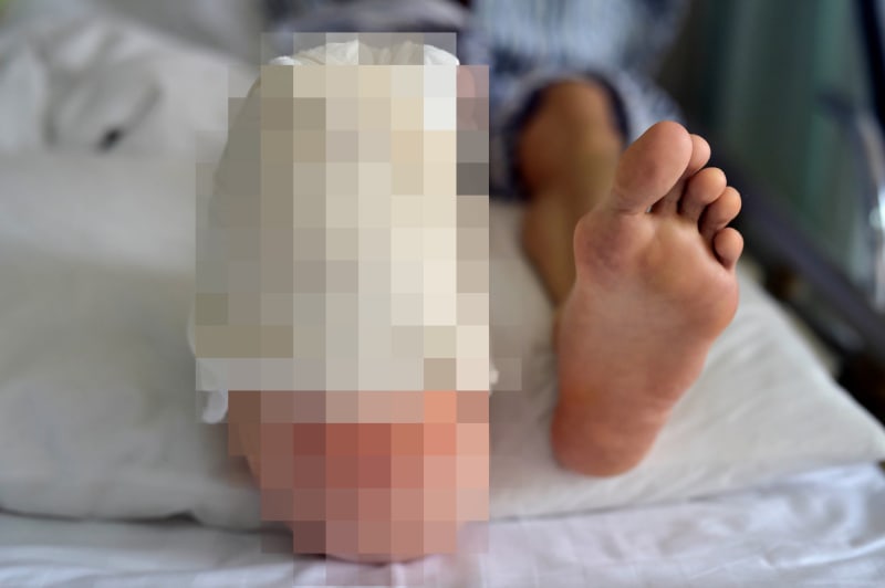 Jak vypadá obří noha po operaci?