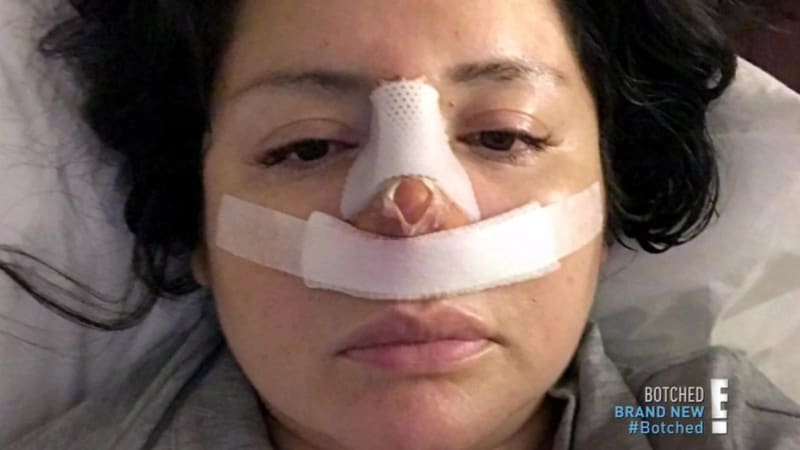 Žena se po liposukci probudila i s plastikou nosu 9
