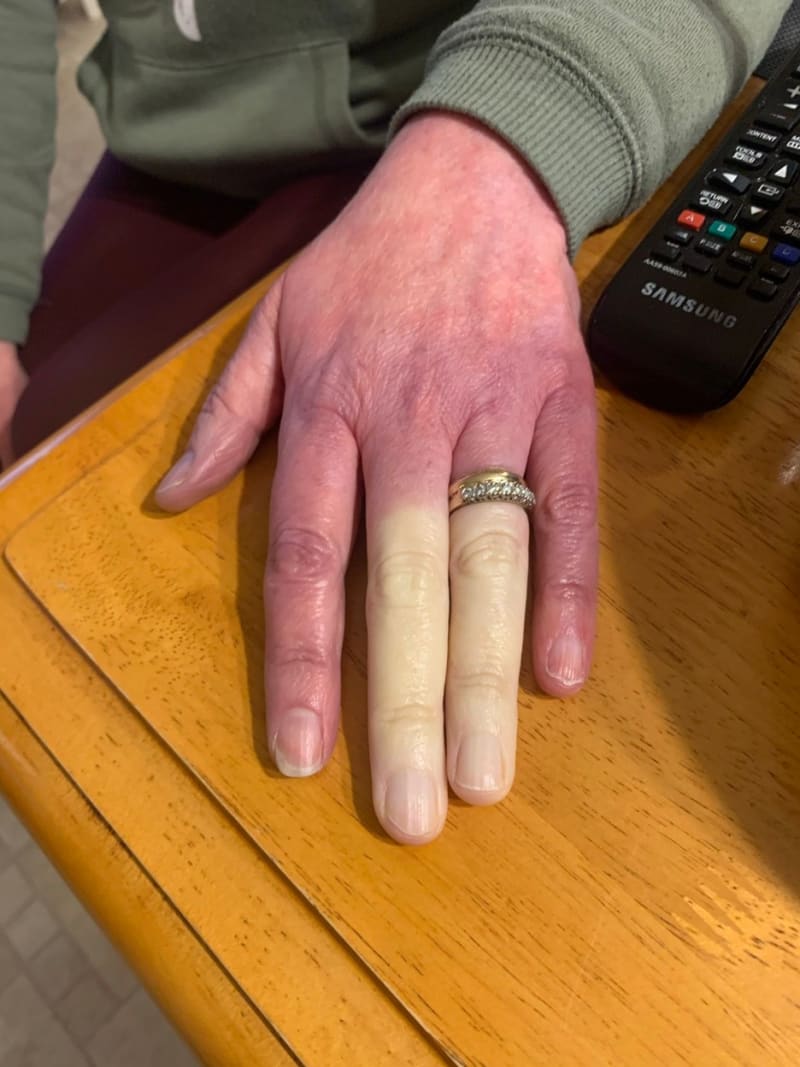 Bílé prsty kvůli vzácné nemoci 2