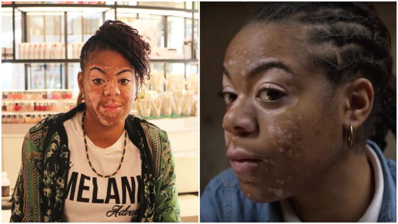 Žena trpí chorobou kůže s názvem vitiligo.