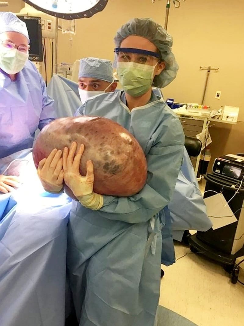 Lékaři vyoperovali ženě obří cystu z vaječníků 5