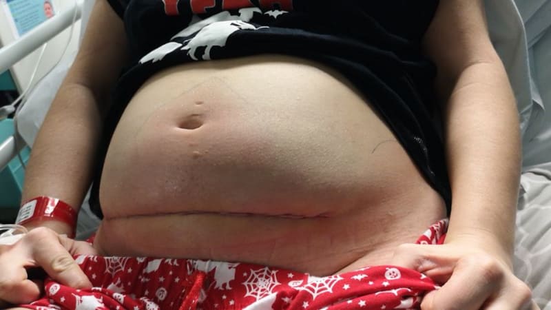 Ženě vyjmuli dítě z dělohy kvůli operaci 1