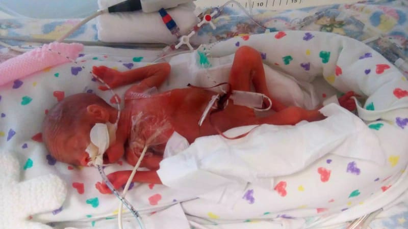 FOTO: Dítě se narodilo tak předčasně, že mu skrz kůži byl vidět mozek! Tyhle fotky nejsou pro každého