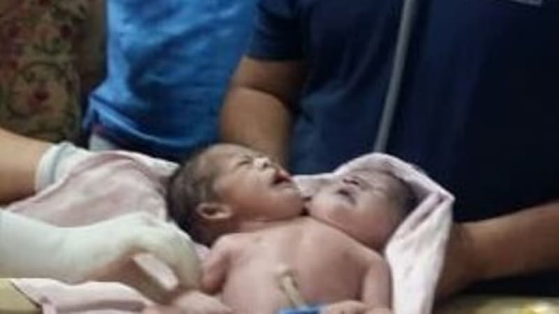 Matce se narodilo místo dvojčat miminko se dvěma hlavami! Může vůbec přežít?