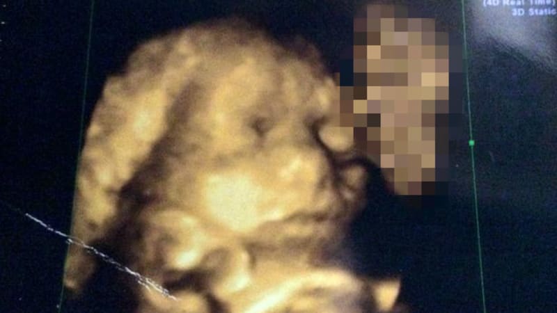 Dívka dostala do ruky ultrazvuk svého dítěte a zděsila se. Její dítě totiž někdo líbal!
