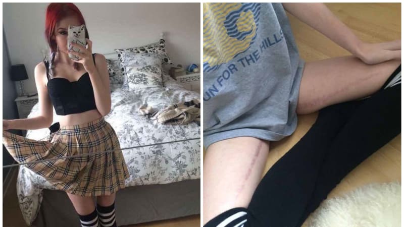 GALERIE: Nemocná dívka na internetu sdílela fotky toho, jak vypadá její tělo pod oblečením. Co se jí stalo?