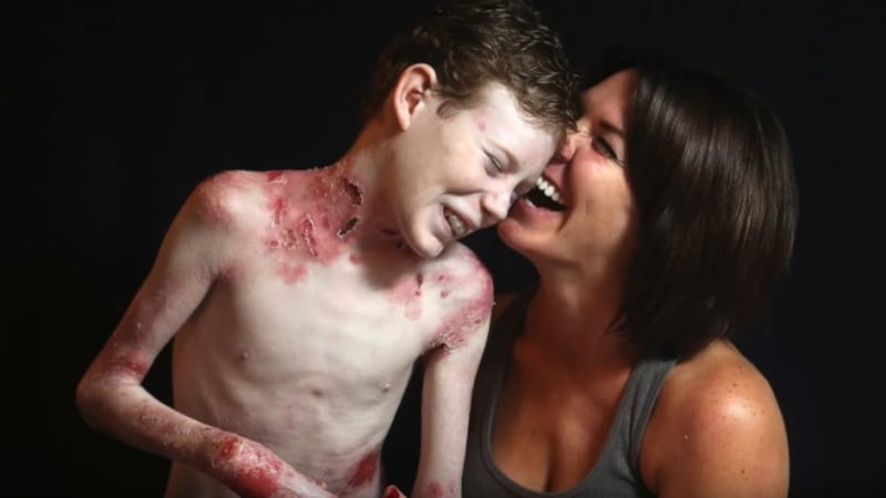 VIDEO: Tragický příběh! Chlapec označovaný jako motýlí dítě zemřel. Záběry z jeho posledních dní vám zlomí srdce