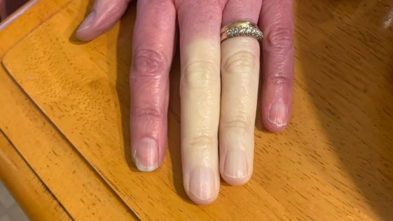 GALERIE: Žena má úplně bílé prsty kvůli vzácné nemoci! Co se jí stalo?