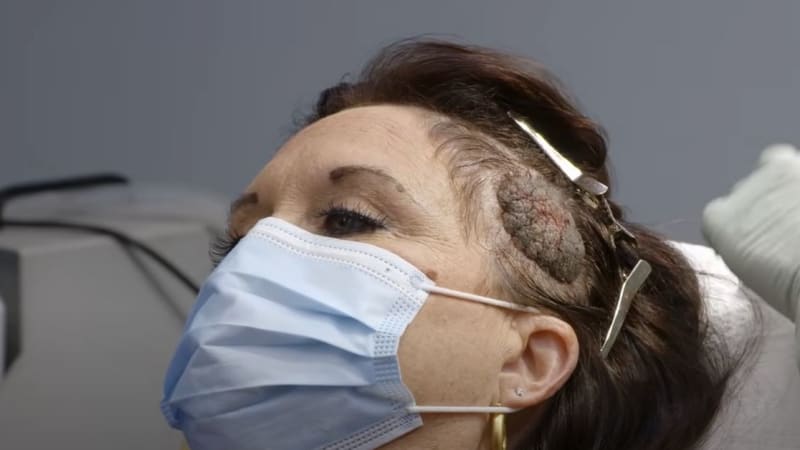 VIDEO: Doktorka odstranila cystu, která vypadala jako houba na hlavě! Jak s tímhle někdo mohl žít?
