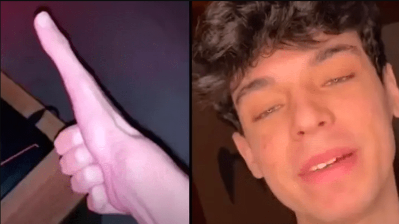 VIDEO: Týpek má obří palec a vypadá jak mimozemšťan! Lekli byste se ho?