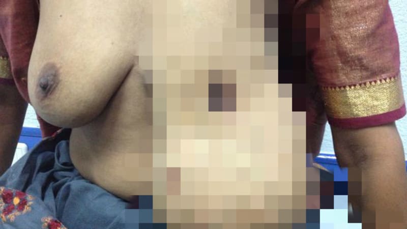 Ženě narostl třetí prs poté, co otěhotněla. Snímky jen pro otrlé!
