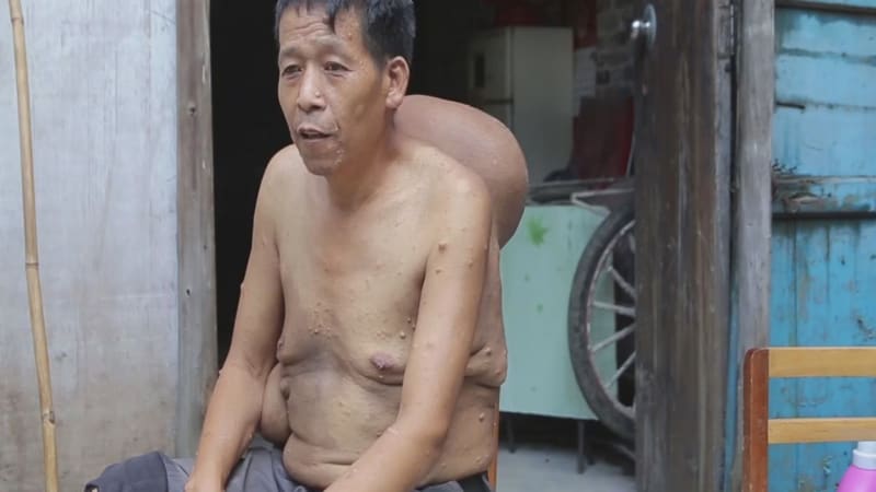 FOTO: Bývalému sportovci z Číny roste na zádech OBŘÍ nádor! Nikdo neví proč
