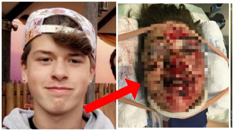 FOTO: Chlapec si zlomil všechny kosti v obličeji při pádu na BMX! Jak vypadal jeho obličej hned po nehodě?