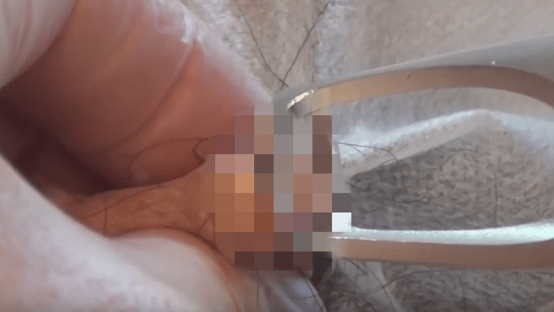 NECHUTNÉ VIDEO: Lékař mu praskl obří cystu na varlatech! Bez umrtvení…