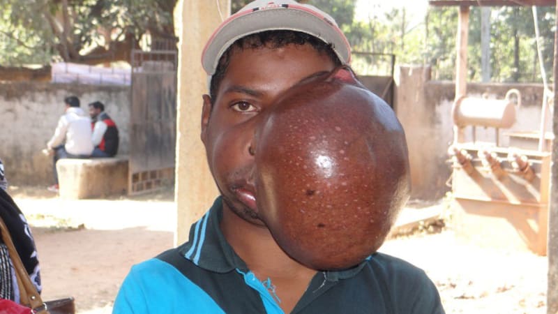 GALERIE: Lékaři odstranili muži obří nádor o velikosti melounu, který mu znetvořil obličej. Jeho proměna vám vyrazí dech