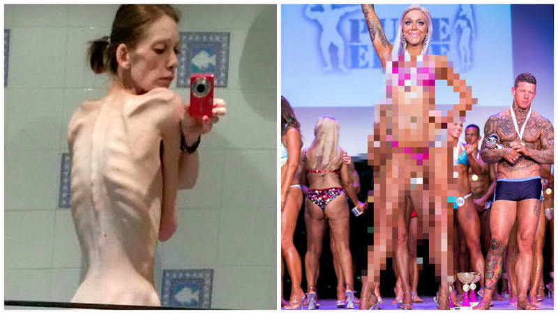 PŘÍBĚH: Tahle dívka kvůli anorexii málem zemřela! Teď je šampionkou v kulturistice. Jak to dokázala?