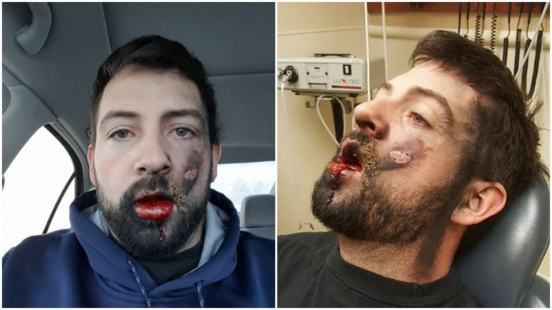 GALERIE: Týpek sdílel šokující fotky následků vybouchlé e-cigarety, která mu explodovala přímo do tváře!
