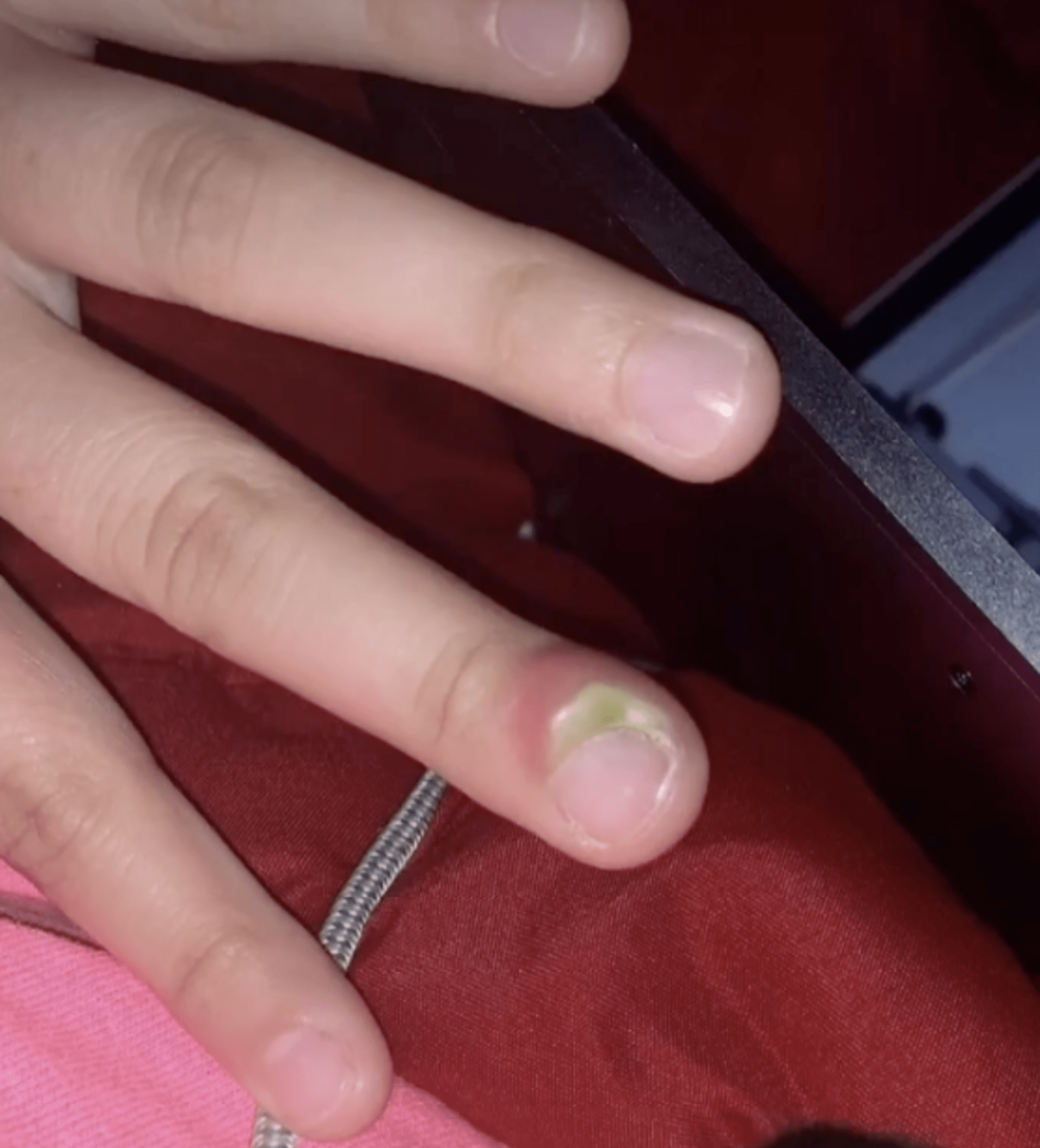 Infekce po kousání nehtů 1