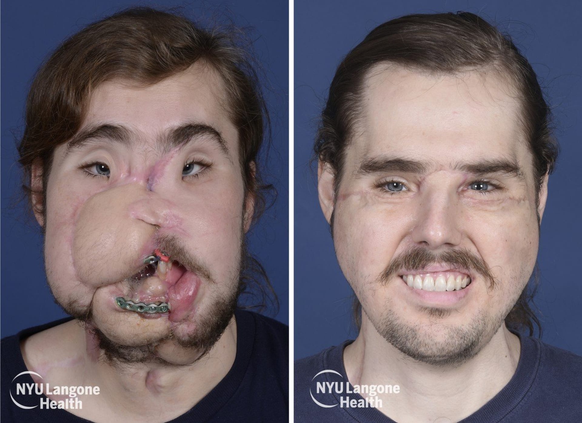Cameron Underwood po transplantaci obličeje. 6