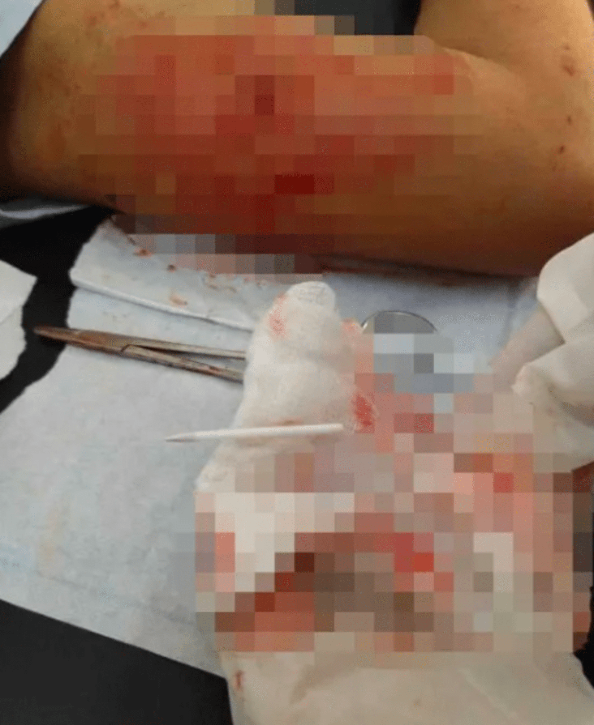 Falešný gynekolog implantoval ženě pod kůži tyčinku od lízátka