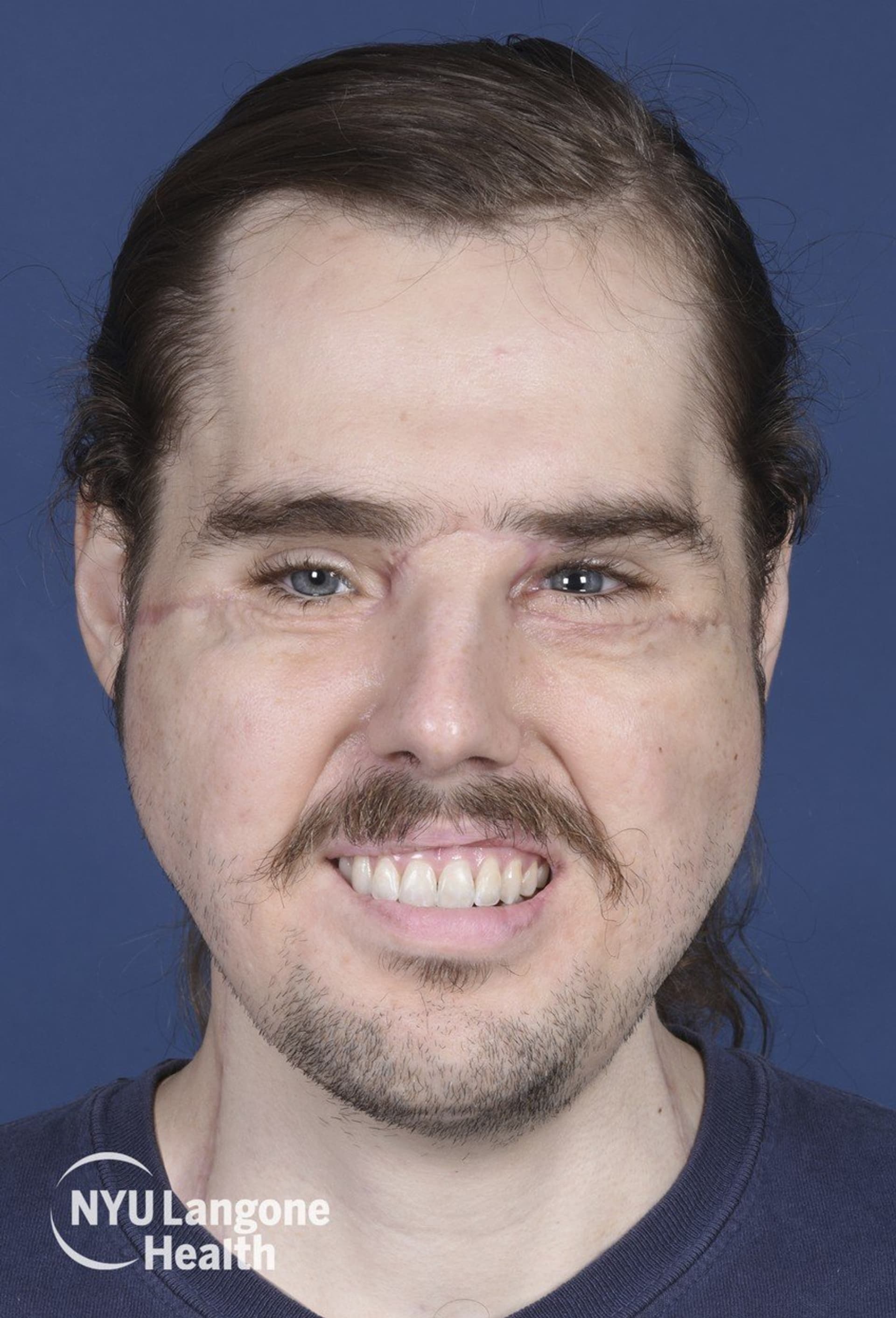 Cameron Underwood po transplantaci obličeje. 2