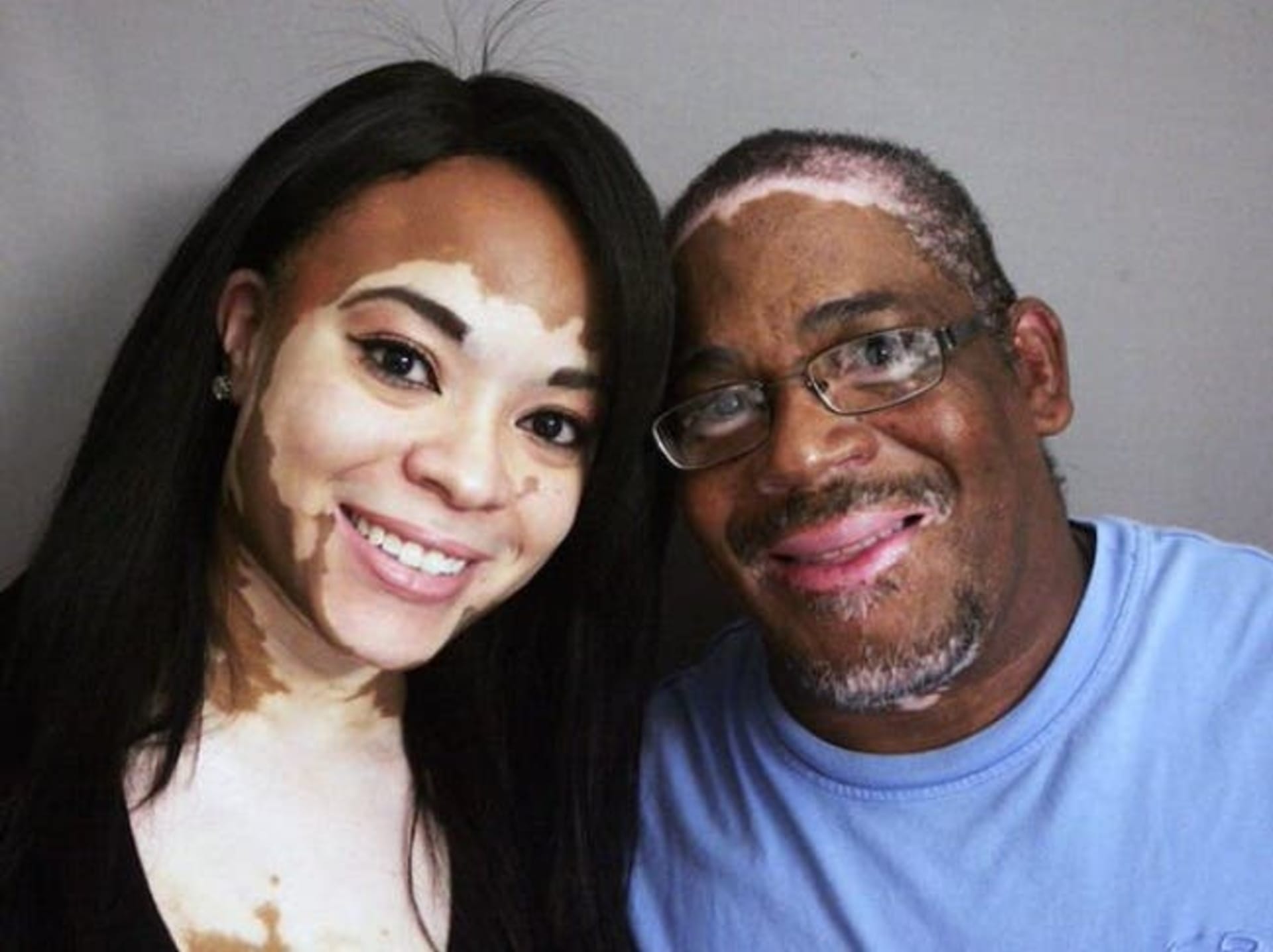 Když otec i dcera trpí vitiligem, nemocí bílých skvrn na kůži.