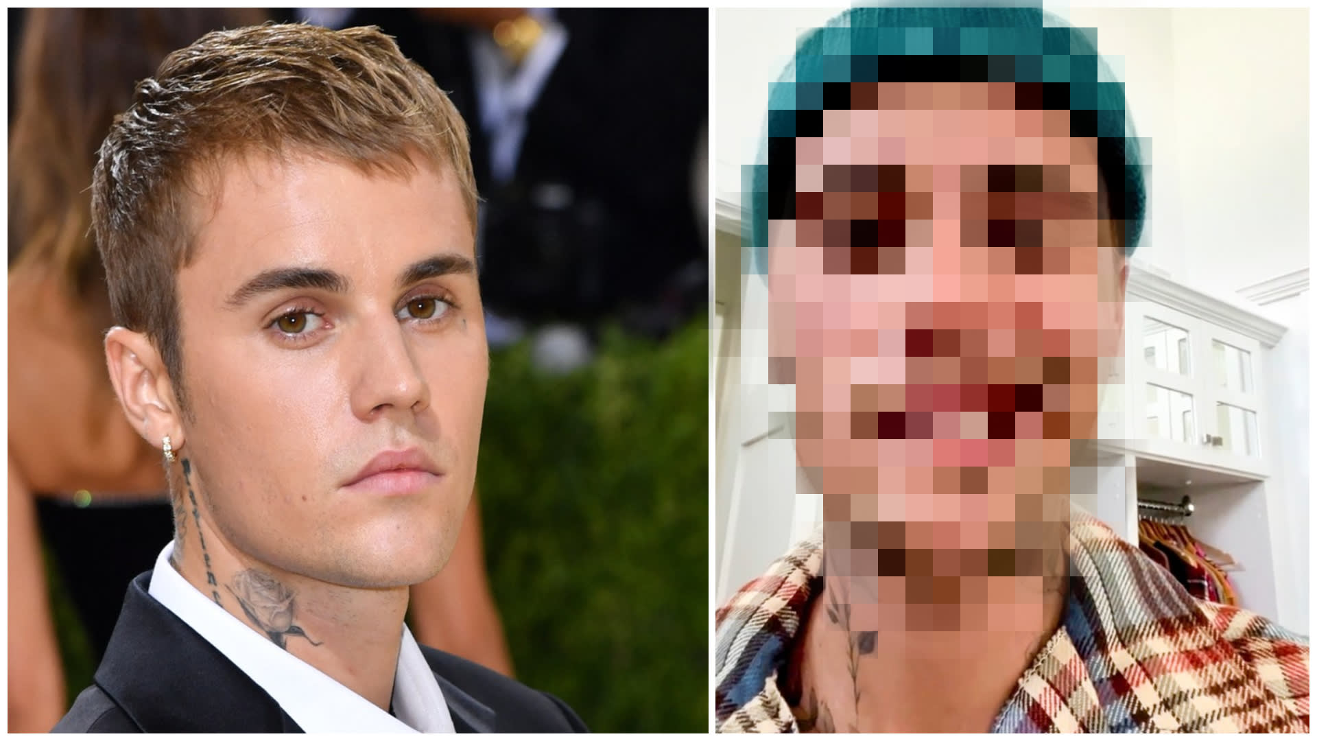 Justin Bieber má ochrnutou polovinu obličeje.