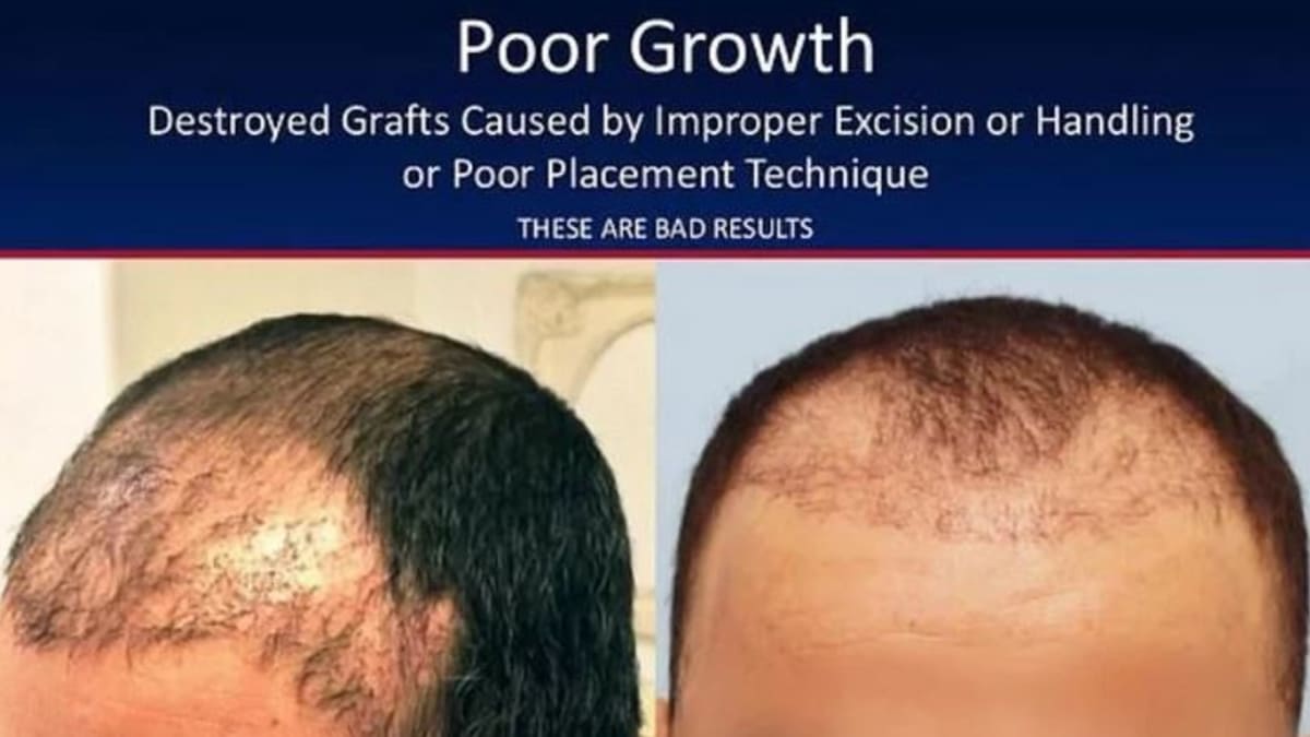 Nepovedené transplantace vlasů 2