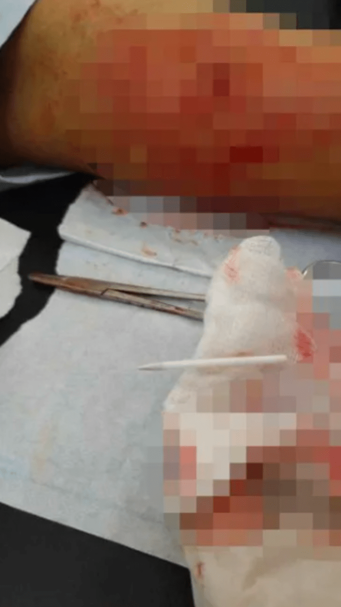 Falešný gynekolog implantoval ženě pod kůži tyčinku od lízátka
