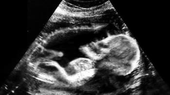 Ultrazvuky miminek, které nevypadají moc jako miminka. Báli byste se jich?