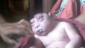 Předčasně narozené dítě se zdeformovanou hlavou