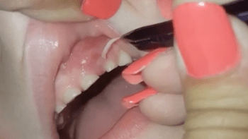 Nehty v dásních