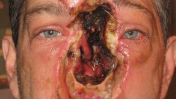 Drsné fotky - rakovina muži vzala oko, nos, i levou tvář