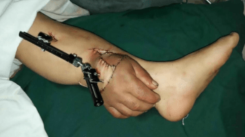 Lékaři přišili ruku k noze pacienta