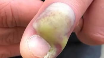 Infekce kvůli kousání nehtů