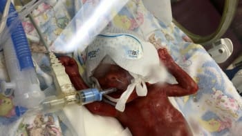 Předčasně narozené dítě bojovalo o život