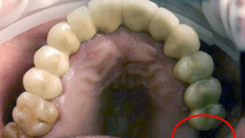 Zub rostl uvnitř varlat